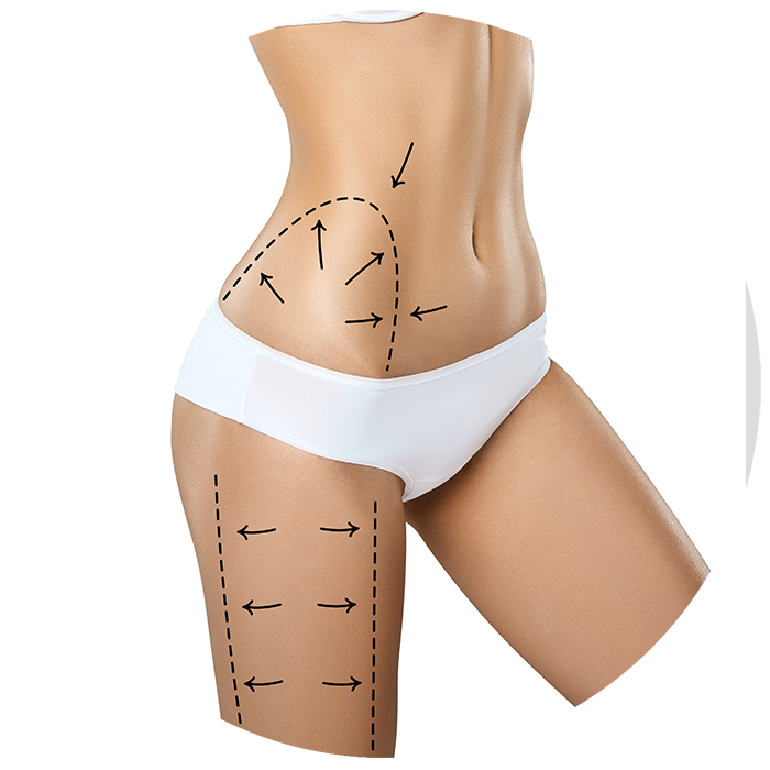 Liposuction-izmir