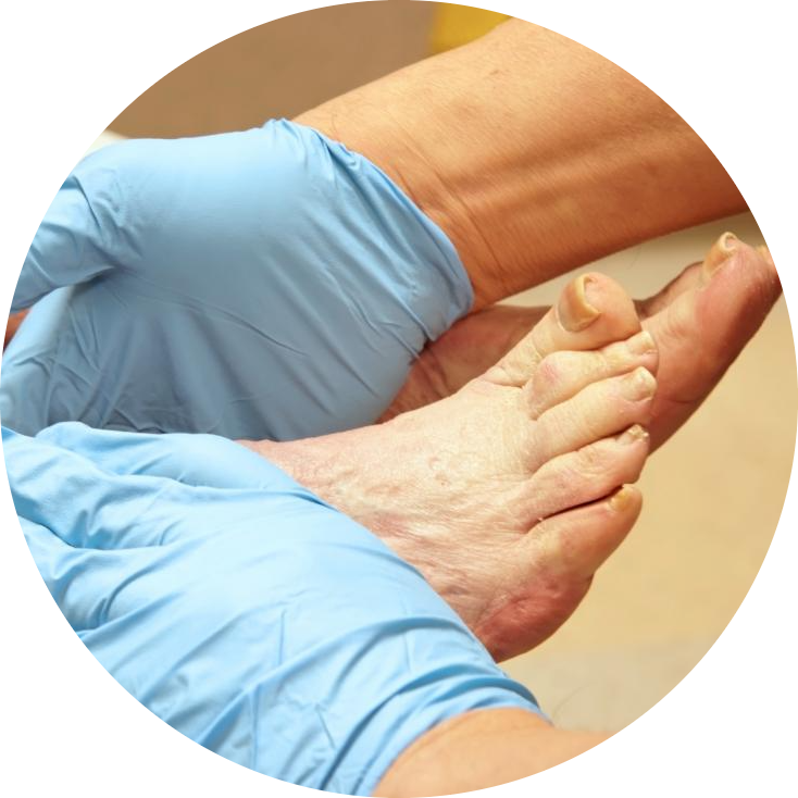 what-are-the-treatments-for-plantar-fibroma_2-photoaidcom-cropped